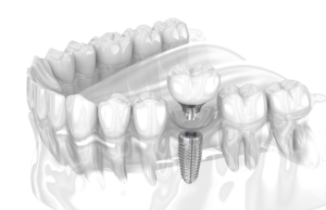 Dental Implant 3D Render